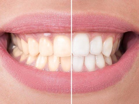 Trattamenti di odontoiatria estetica Trattamenti di odontoiatria estetica