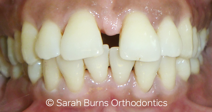 catherine before treatment