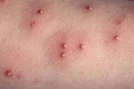 Irritation From the Flea Bites — Irmo, SC — Baine Termite and Pest Control