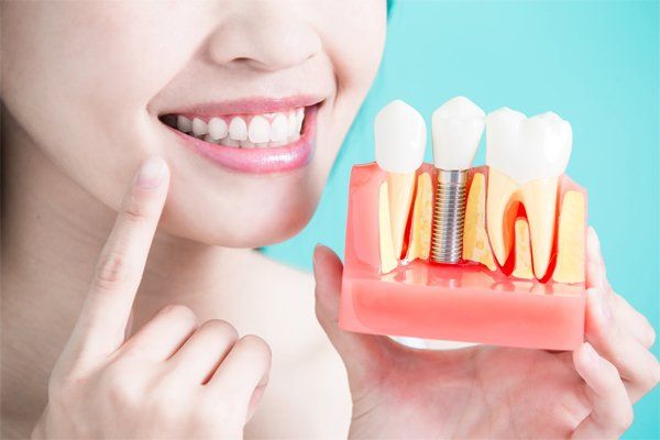 Woman smiling, pointing to dental implant model. Model shows a tooth implant with gums and bone.