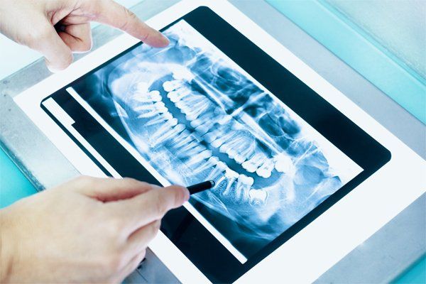 Dental X-ray being examined with a pointing finger and a stylus on a light box.