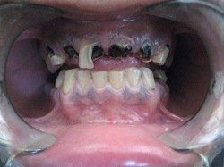 Patient Smile Before 
