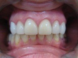 Patient Smile After 
