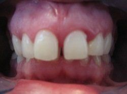 Patient Smile Before 