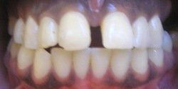 Patient Smile Before 