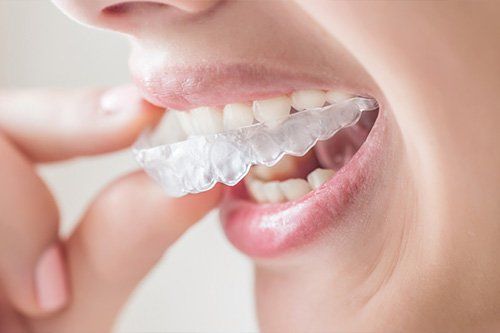 Person inserting clear aligner into mouth.