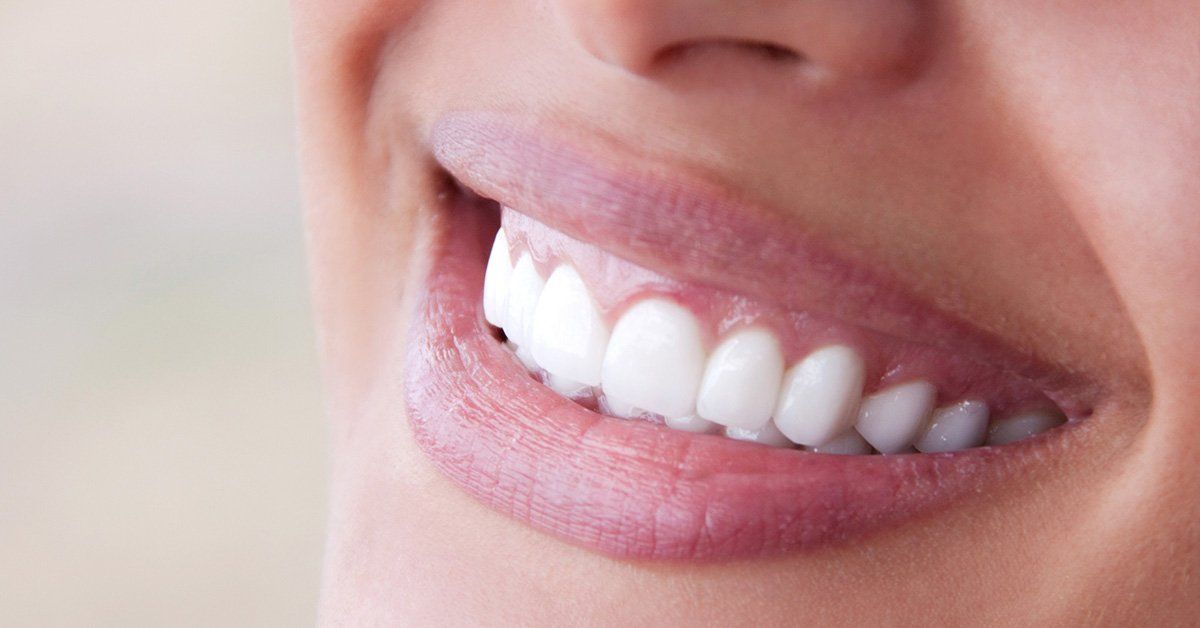porcelain veneers