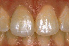 Close-up of two front teeth, pearly white with subtle vertical striations.
