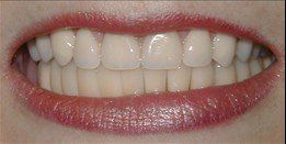 upper/lower arch rehabilitation after