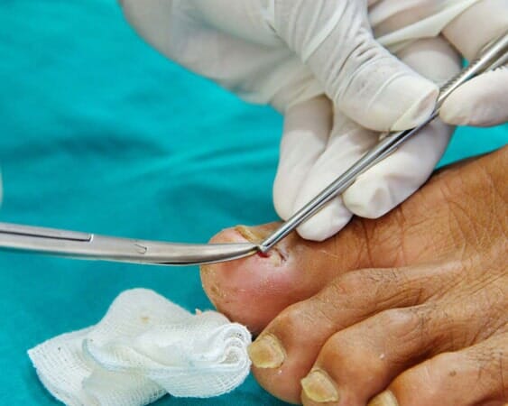 Ingrown nail