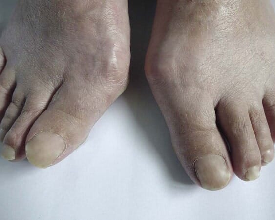 Bunions