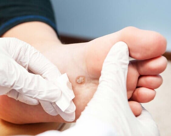 Wart