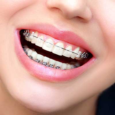 Close-Up Of Young Person With Braces Smiling