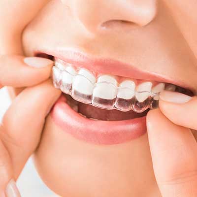 Closeup of invisalign on patient