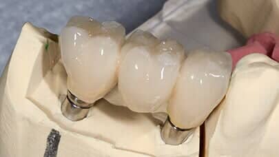Dental Implant - Affordable dental care in Portland, OR