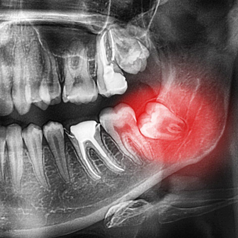 dente incluso