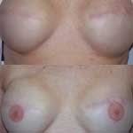 breasts before and after