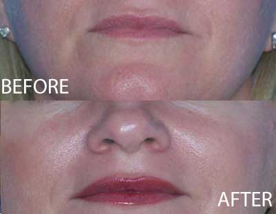 PERMANENT LIP PROCEDURES