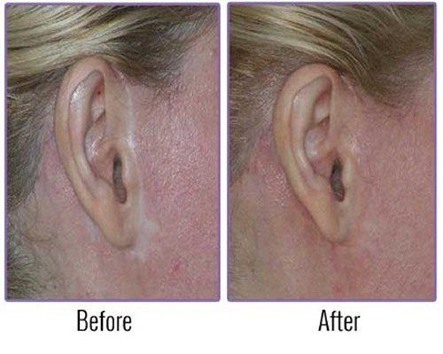 Before and After Scar Camouflage