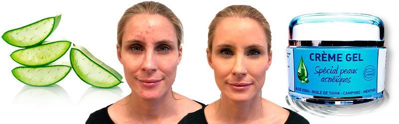 Crème Gel soin du visage à l'aloe vera pour peaux acnéiques Crème Gel soin du visage à l'aloe vera pour peaux acnéiques