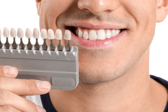 applicazione faccette ceramica