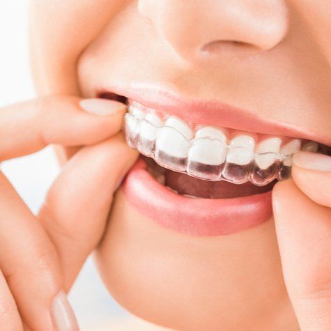 apparecchio Invisalign