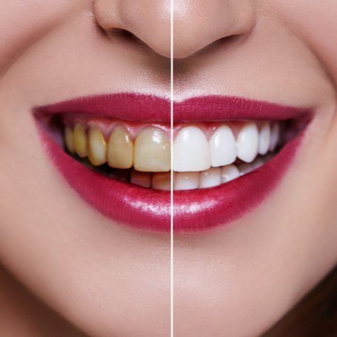 sbiancamento dentale