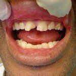 Close-up of a smiling mouth with missing front teeth and visible gums
