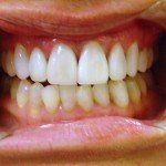Close-up of a smiling mouth showing white upper teeth and yellowed lower teeth