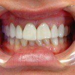Close-up of a mouth with lips pulled back, showing straight white teeth and gums