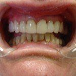 Close-up of an open mouth showing misaligned upper and lower teeth with clear dental retractors.