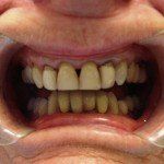 Close-up of a smiling mouth with uneven yellowed teeth and dark gaps between them
