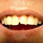 Close-up of a smiling mouth with yellowed teeth and a small gap in the front teeth