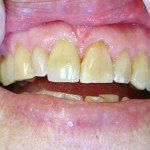 Close-up of crooked yellow upper teeth with red, irritated gums and a gap from missing lower teeth