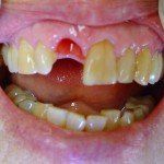 Close-up of a mouth with the upper front teeth missing and upper gums exposed