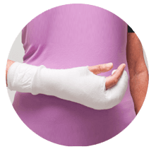 Woman in cast