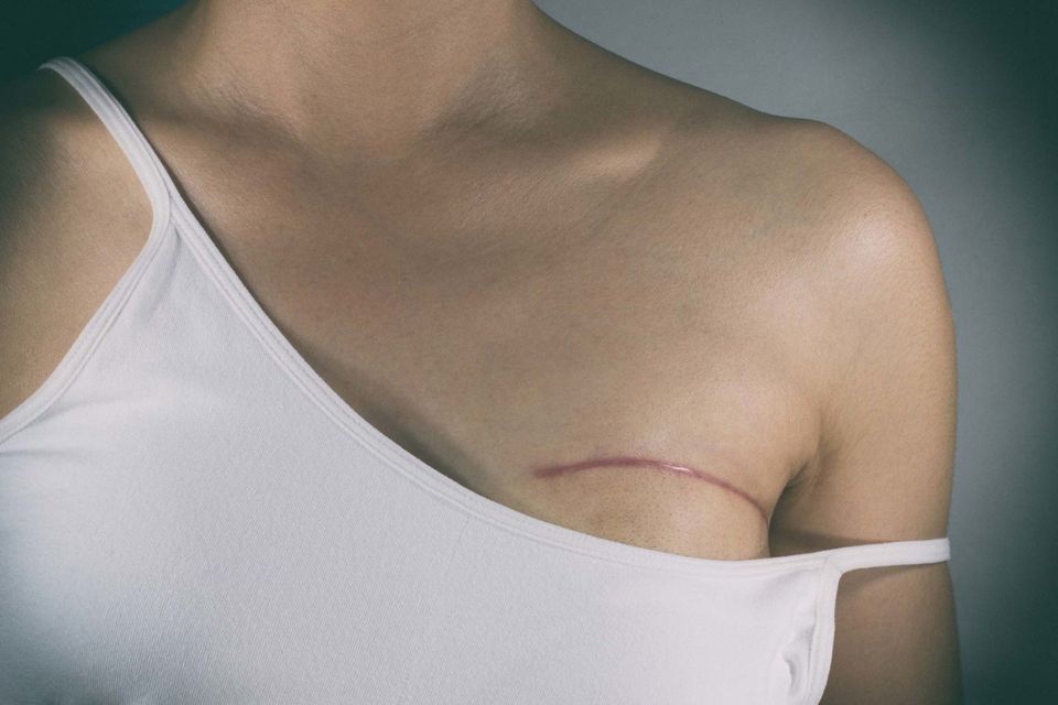 Breast Cancer Surgery Scars — Saginaw, MI — Barry, Ronald C MD Breast Cancer Surgery Scars — Saginaw, MI — Barry, Ronald C MD