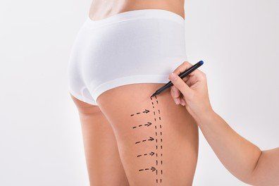 Thighplasty