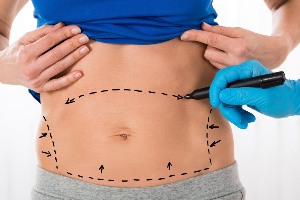 Abdominoplasty