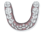 Affollamento dentale