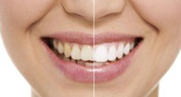 strumenti del dentista