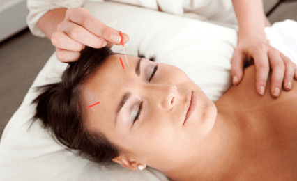 A lady having acupuncture in her forehead
