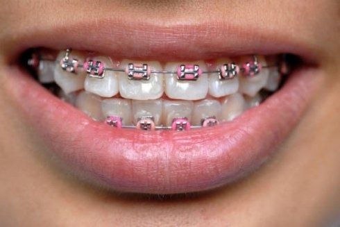 Apparecchio denti fisso