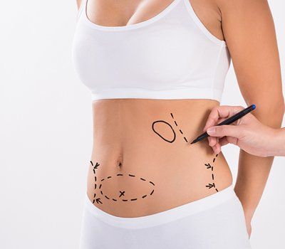 Tummy Tucks — Patient With Guide Marks In Her Tummy in Orlando, FL Tummy Tucks — Patient With Guide Marks In Her Tummy in Orlando, FL