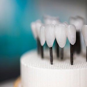 Dental Implant — Dental Restoration in Bonita Springs, FL Dental Implant — Dental Restoration in Bonita Springs, FL