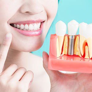 Dental Implant — Dental Restoration in Bonita Springs, FL Dental Implant — Dental Restoration in Bonita Springs, FL