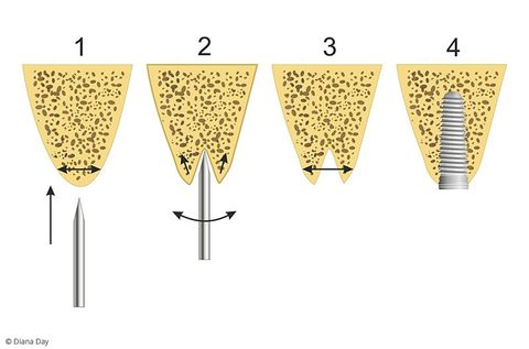 Bone-Spreading: Knochenspreizung für zu schmalen Kieferkamm