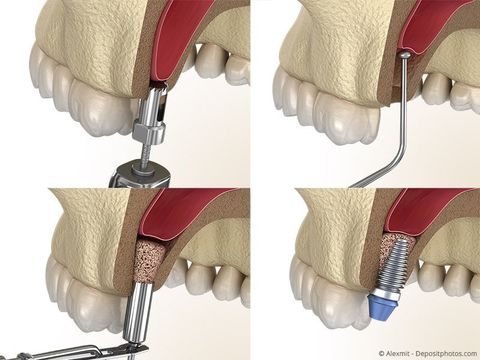 Sinus-Lift: Anhebung des Kieferhöhlenbodens mit Knochen oder Knochen-Ersatzmaterial