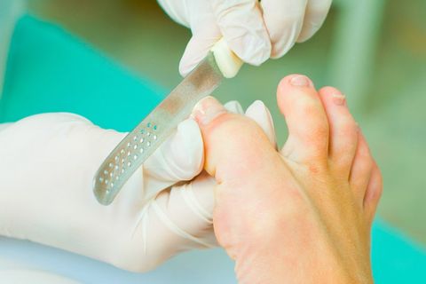 Athlete's foot