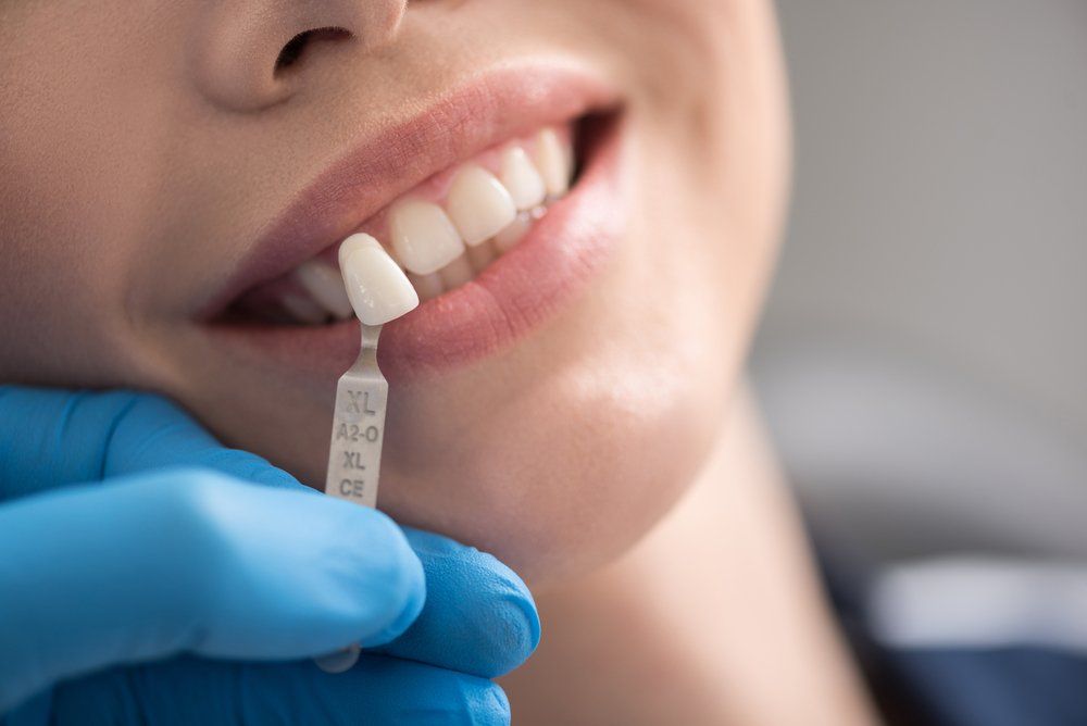 Matching Implant Overdenture Sample — Ballina Denture Clinic Michael J Parker in Ballina, NSW